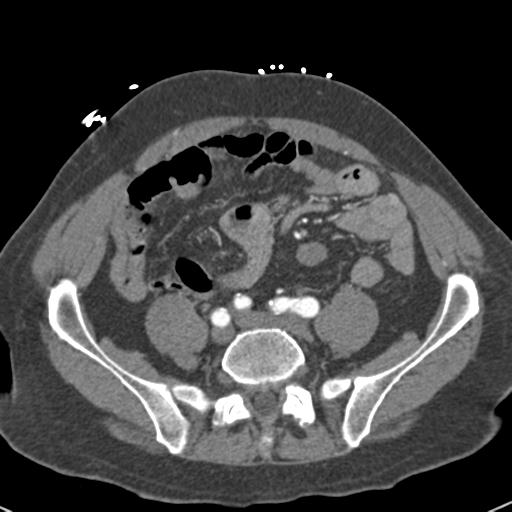 Aortic intramural hematoma (Radiopaedia 31139-31838 B 131).jpg