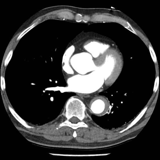 Aortic intramural hematoma (type B) (Radiopaedia 79323-92387 B 33).jpg
