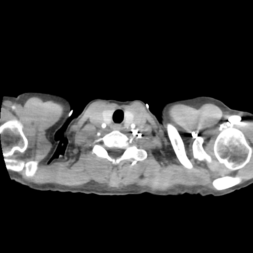 Aortic valve non-coronary cusp thrombus (Radiopaedia 55661-62189 B 1).png