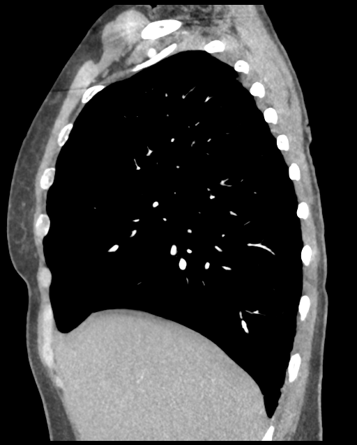 Aortic valve non-coronary cusp thrombus (Radiopaedia 55661-62189 D 39).png