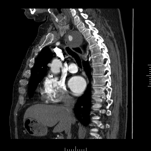 File:Aorto-coronary bypass graft aneurysms (Radiopaedia 40562-43157 C 14).png