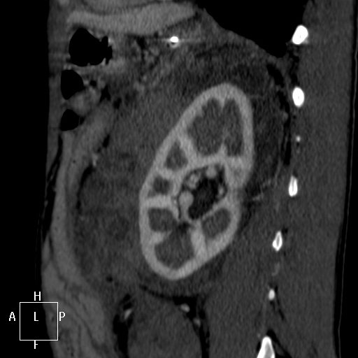 File:Aorto-left renal vein fistula (Radiopaedia 45534-49628 C 51).jpg