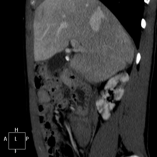 Aorto-left renal vein fistula (Radiopaedia 45534-49628 C 7).jpg