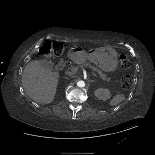 Aortoesophageal fistula with endovascular repair (Radiopaedia 73781-84592 Axial C+ CTPA 196).jpg