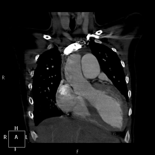 File:Aortopulmonary septal defect (Radiopaedia 41990-45013 Coronal C+ CTPA 15).jpg