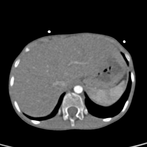 File:Aortopulmonary window, interrupted aortic arch and large PDA giving the descending aorta (Radiopaedia 35573-37074 B 89).jpg