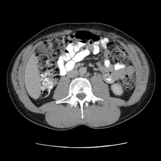 File:Appendicitis complicated by post-operative collection (Radiopaedia 35595-37113 A 35).jpg