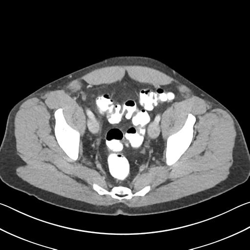 Appendicitis with cecal bar sign (Radiopaedia 31878-32830 B 69).jpg