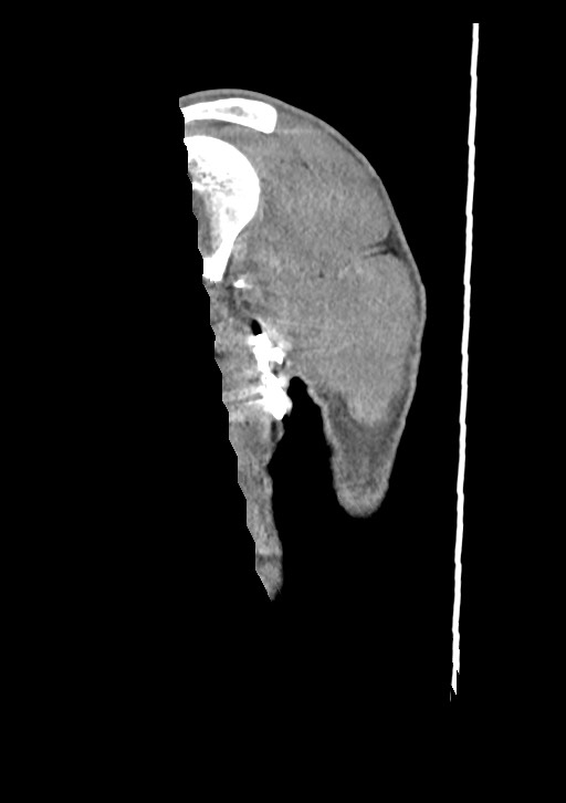 Arrow injury in the neck (Radiopaedia 75268-86390 G 6).jpg