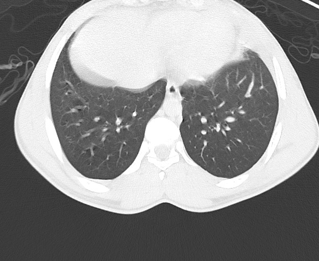 Arrow injury to the chest (Radiopaedia 75223-86321 Axial lung window 68).jpg
