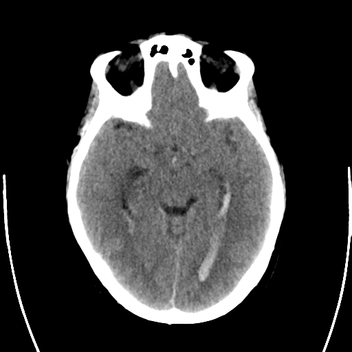 File:Arteriovenous malformation (cerebral) (Radiopaedia 40070-42579 Axial non-contrast 14).png