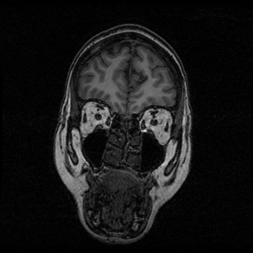 Arteriovenous malformation (cerebral) (Radiopaedia 40070-42580 Coronal T1 51).png
