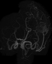 File:Arteriovenous malformation - cerebral (Radiopaedia 15901-15546 MRA 1).jpg