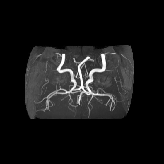 Artery of Percheron infarct (Radiopaedia 40966-43676 F 57).jpg