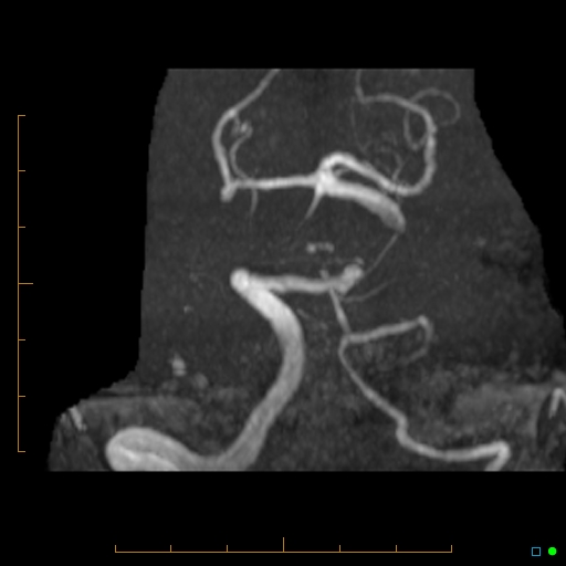 File:Artifactual basilar artery stenosis due to metallic stent (Radiopaedia 31206-31922 3D MIP 1).jpg