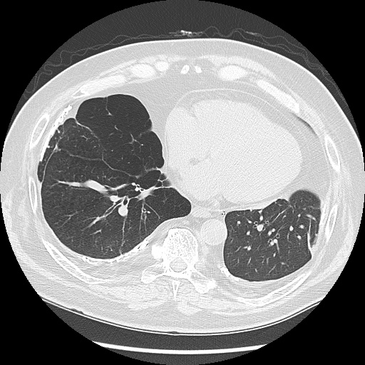Asbestos-related pleural disease (Radiopaedia 74366-85250 Axial lung window 79).jpg