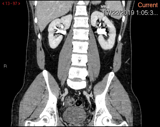 File:Ascending colonic diverticulum mimicking acute appendicitis (Radiopaedia 69943-80198 B 97).jpg