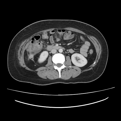 Ascending retrocecal appendicitis with liver abscesses (Radiopaedia 60066-67615 B 46).jpg