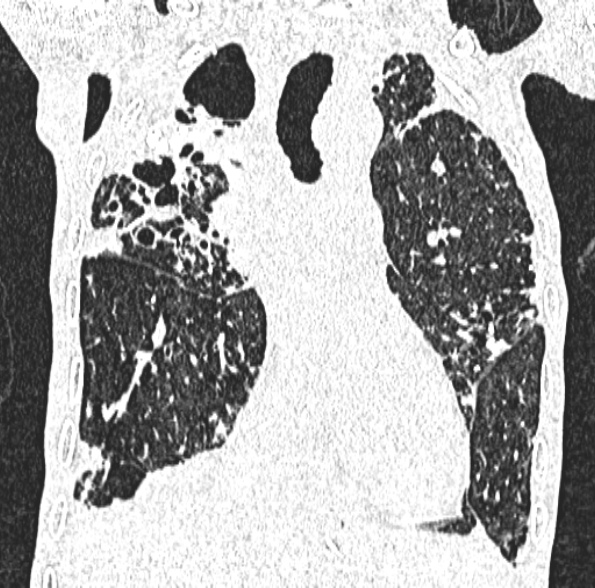 Aspergilloma- with Monod sign (Radiopaedia 44737-48532 Coronal lung window 222).jpg