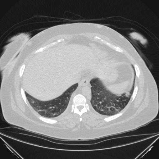 Aspergilloma (Radiopaedia 39611-41932 Axial lung window 110).jpg