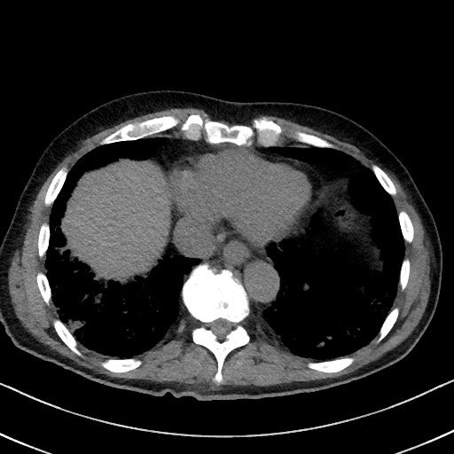 Aspergilloma on background pulmonary fibrosis (Radiopaedia 60942-68757 Axial non-contrast 44).jpg
