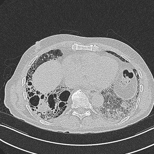 File:Aspergilloma on background pulmonary fibrosis (Radiopaedia 60942-68757 B 37).jpg