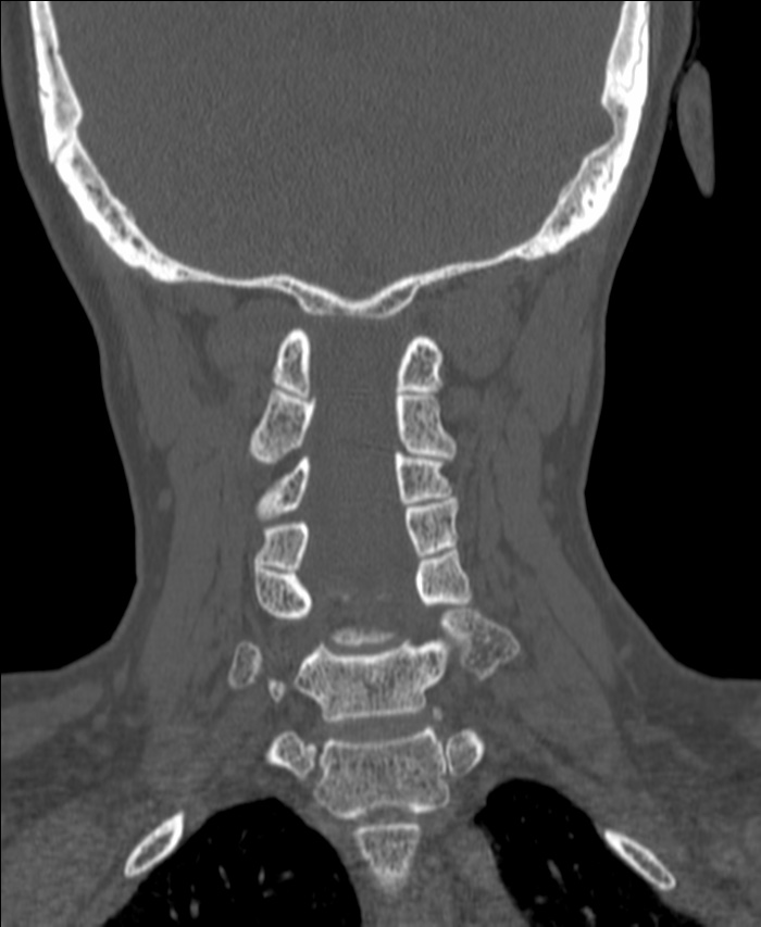 Atlanto-occipital assimilation with basilar invagination (Radiopaedia 70122-80188 Coronal bone window 139).jpg