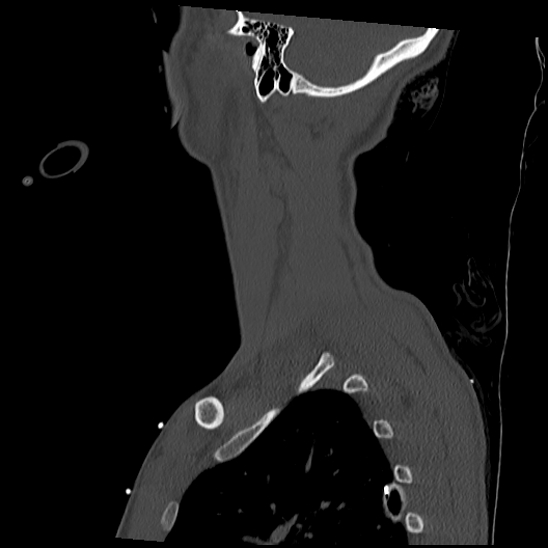 Atlanto-occipital dissociation (Traynelis type 1), C2 teardrop fracture, C6-7 facet joint dislocation (Radiopaedia 87655-104061 Sagittal bone window 60).jpg