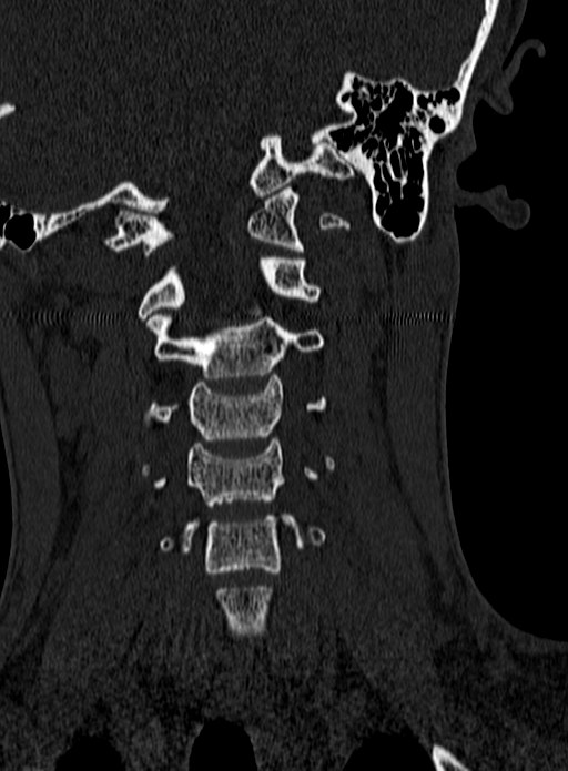 Atlantoaxial subluxation (Radiopaedia 44681-48450 Coronal bone window 52).jpg