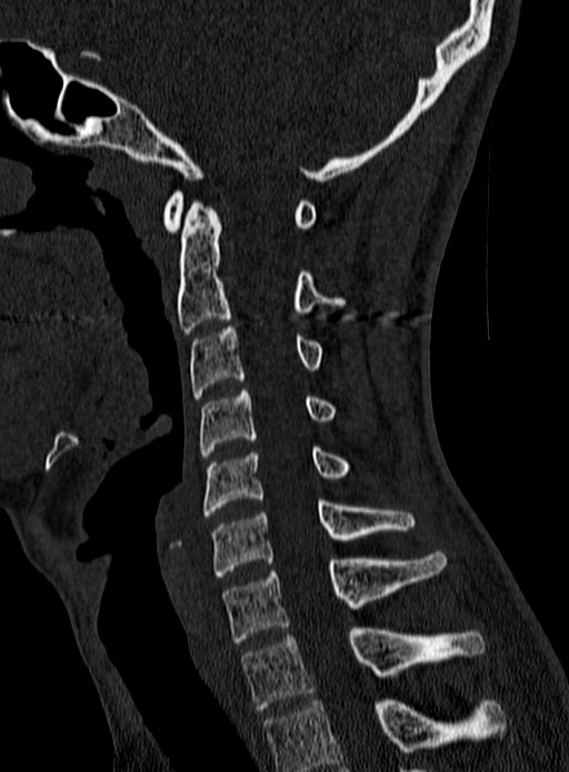 Atlantoaxial subluxation (Radiopaedia 44681-48450 Sagittal bone window 77).jpg