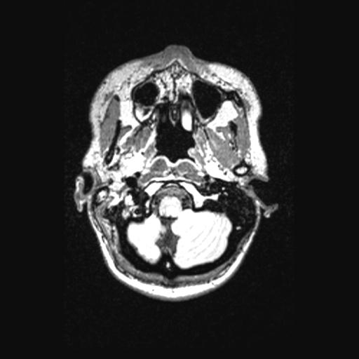 Atretic encephalocoele with inferior vermis hypoplasia (Radiopaedia 30443-31108 Axial 25).jpg