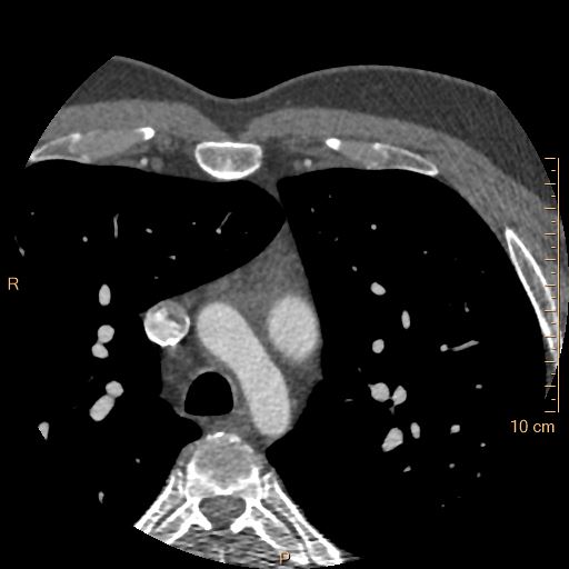 Atrial septal defect (upper sinus venosus type) with partial anomalous pulmonary venous return into superior vena cava (Radiopaedia 73228-83961 A 12).jpg