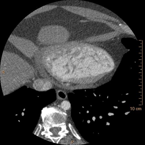 Atrial septal defect (upper sinus venosus type) with partial anomalous pulmonary venous return into superior vena cava (Radiopaedia 73228-83961 A 233).jpg