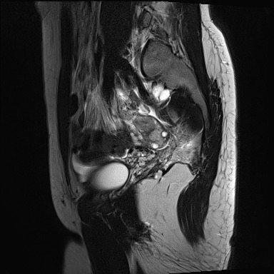 File:Atypical deep infiltrating endometriosis (Radiopaedia 44470-48125 Sagittal T2 4).jpg