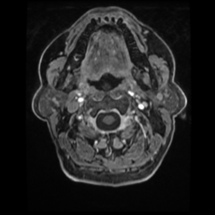 Atypical meningioma (Radiopaedia 45535-49629 Axial T1 C+ 7).jpg