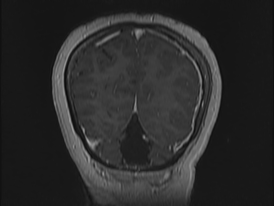 Atypical meningioma (Radiopaedia 62985-71406 Coronal T1 C+ 109).jpg