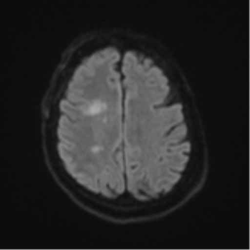 Atypical meningioma (WHO Grade II) (Radiopaedia 54742-60981 Axial DWI 48).png