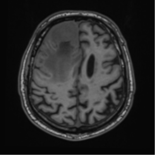 File:Atypical meningioma (WHO grade II) with brain invasion (Radiopaedia 57767-64729 Axial T1 37).png