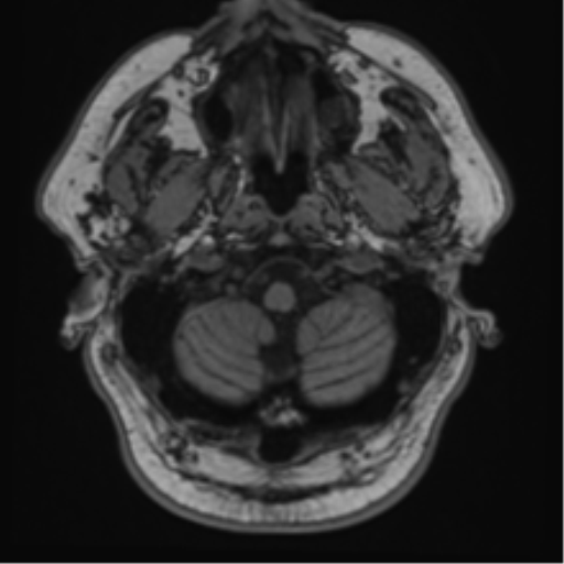 File:Atypical meningioma (WHO grade II) with brain invasion (Radiopaedia 57767-64729 Axial T1 4).png