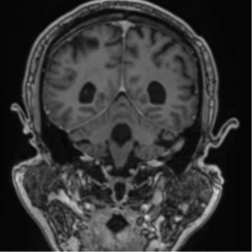 Atypical meningioma (WHO grade II) with brain invasion (Radiopaedia 57767-64729 Coronal T1 C+ 58).png