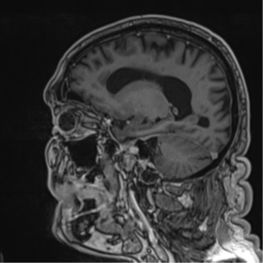 Atypical meningioma (WHO grade II) with brain invasion (Radiopaedia 57767-64729 Sagittal T1 C+ 28).png