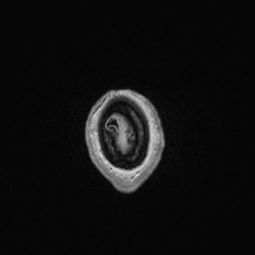 Atypical meningioma (grade II) - en plaque (Radiopaedia 29633-30147 Axial T1 C+ 172).jpg