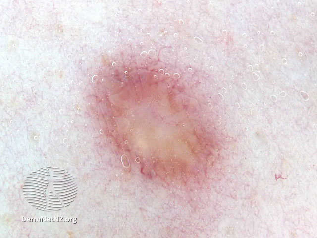 File:Atypical naevus (DermNet NZ doctors-dermoscopy-course-images-vasc).jpg