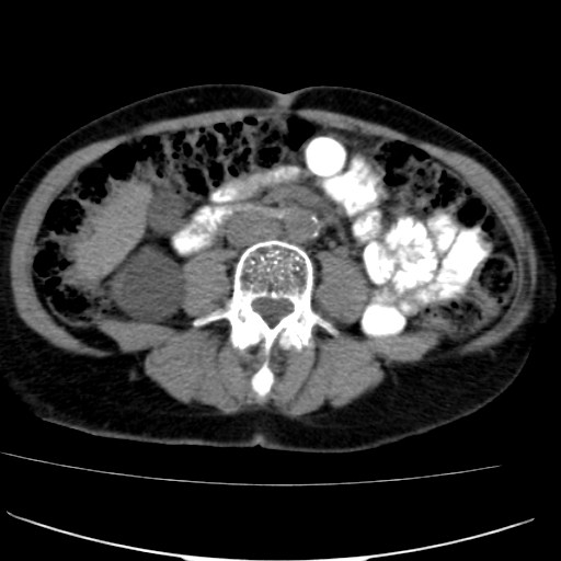 File:Atypical renal cyst (Radiopaedia 17536-17251 non-contrast 26).jpg