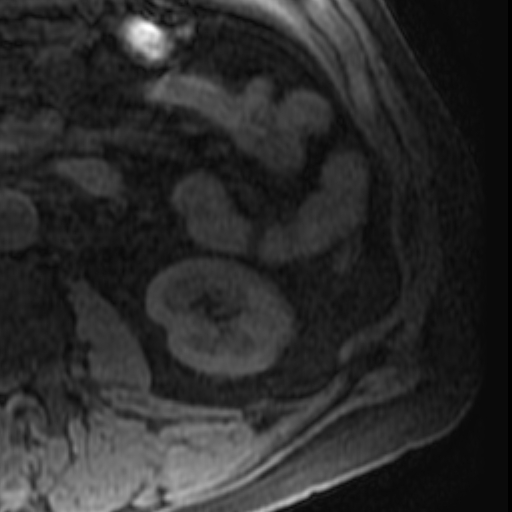 File:Atypical renal cyst on MRI (Radiopaedia 17349-17046 Axial T1 fat sat 24).jpg
