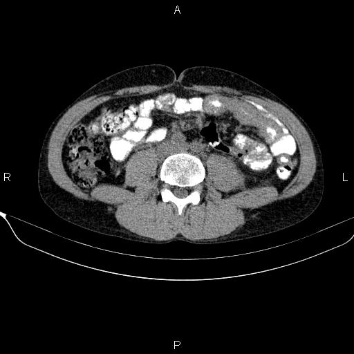 Autoimmune pancreatitis (Radiopaedia 84925-100431 Axial non-contrast 33).jpg