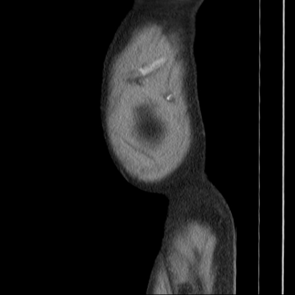 Autosomal dominant polycystic kidney disease (Radiopaedia 36539-38101 D 6).jpg