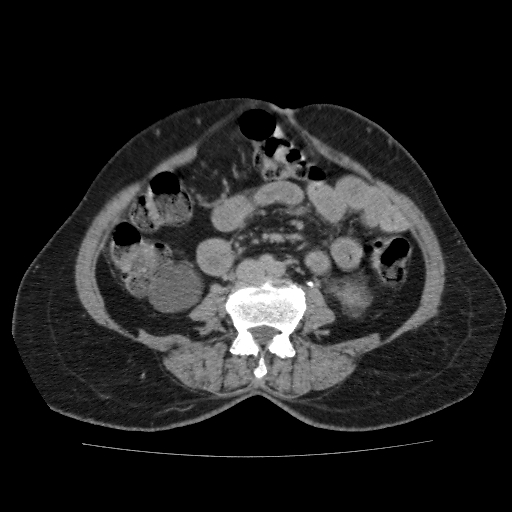 File:Autosomal dominant polycystic kidney disease (Radiopaedia 38189-40194 Axial C+ delayed 31).jpg