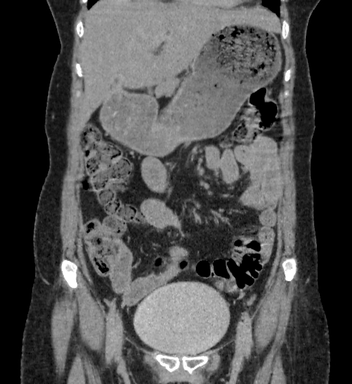 Autosomal dominant polycystic kidney disease (Radiopaedia 38189-40194 Coronal C+ delayed 19).jpg