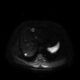 File:Autosomal dominant polycystic kidney disease (Radiopaedia 50259-55611 Axial DWI 42).jpg